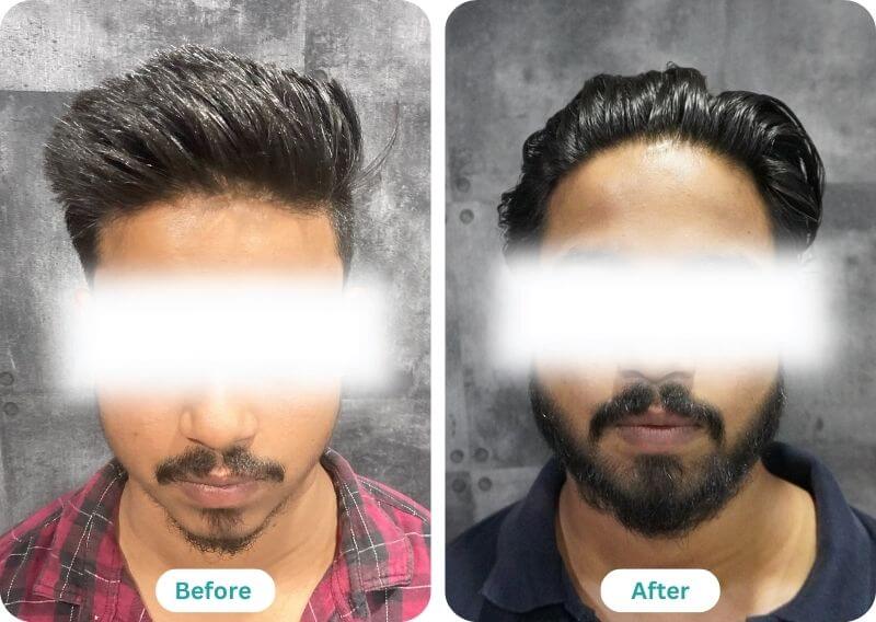 beard transplant before and after result